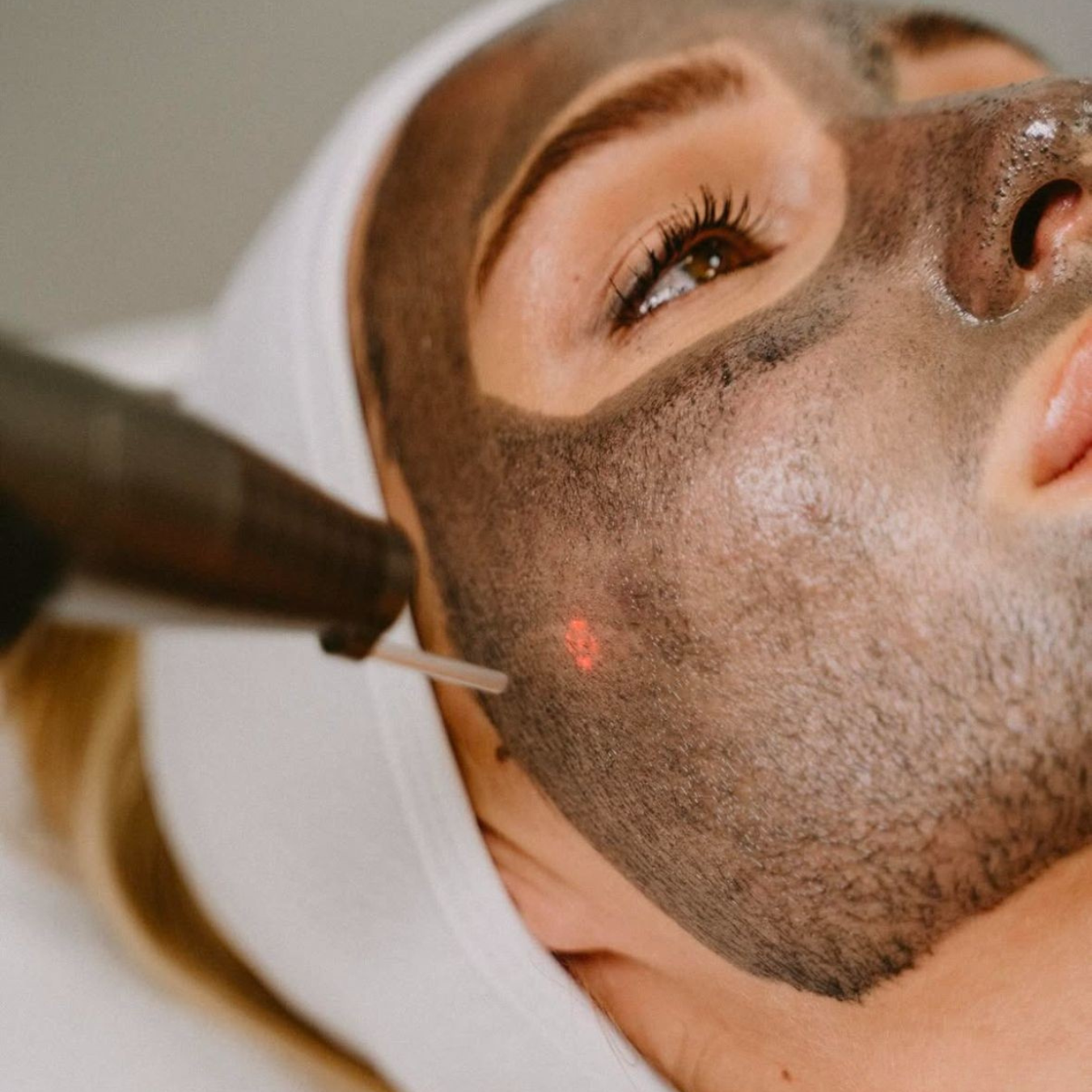 Carbon Laser Peel