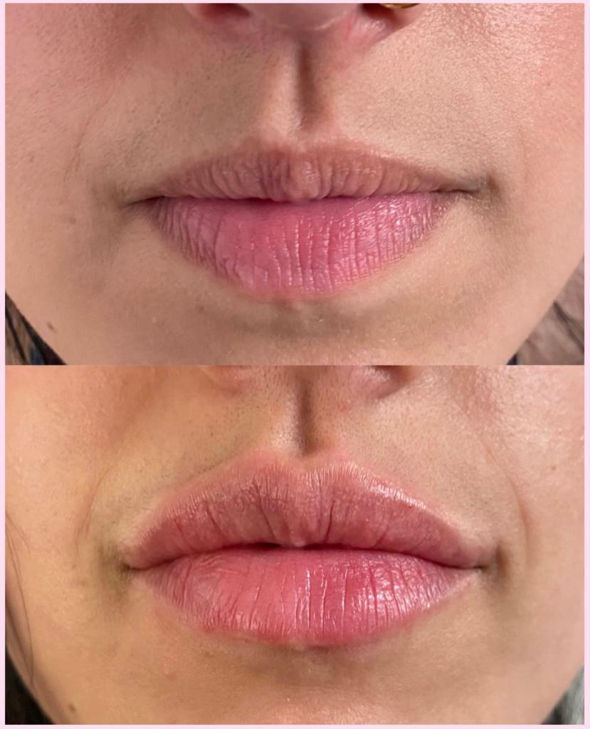 before and after dermal filler injectables