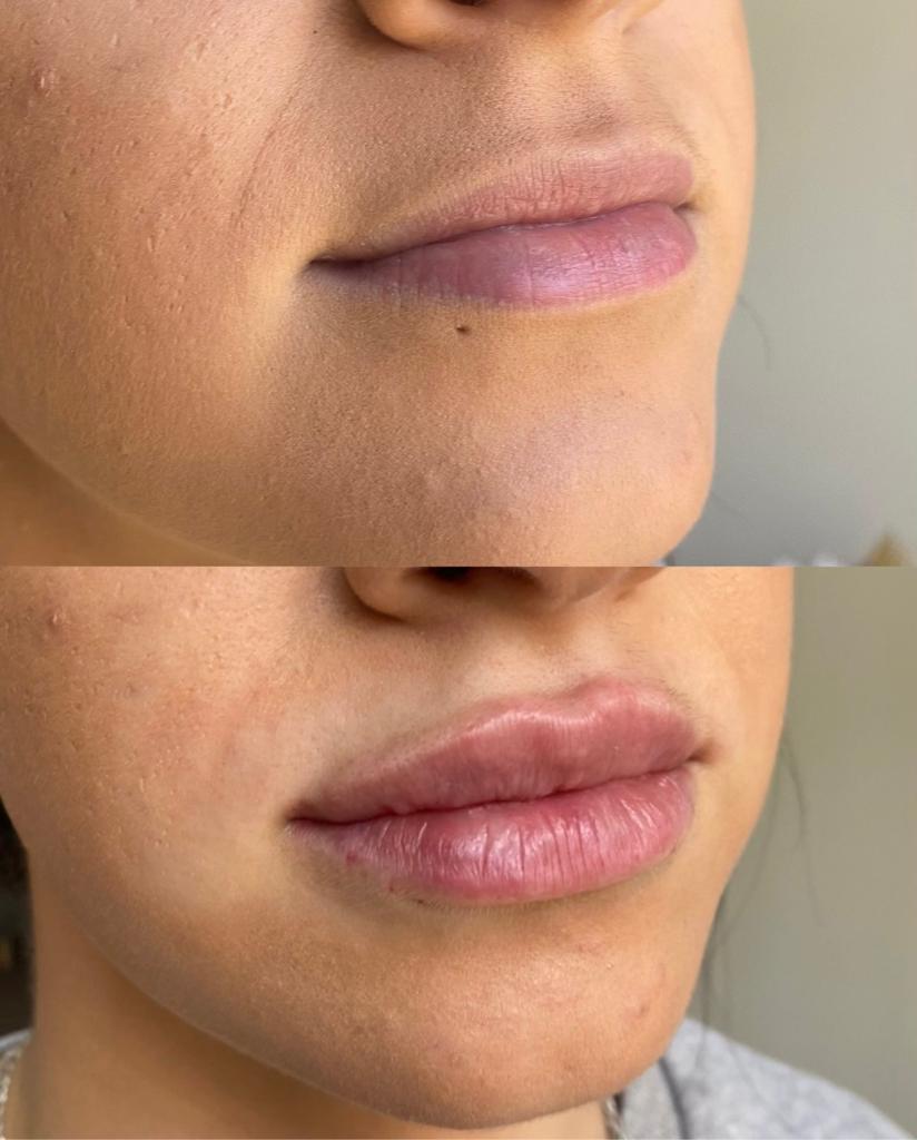 before and after dermal filler injectables
