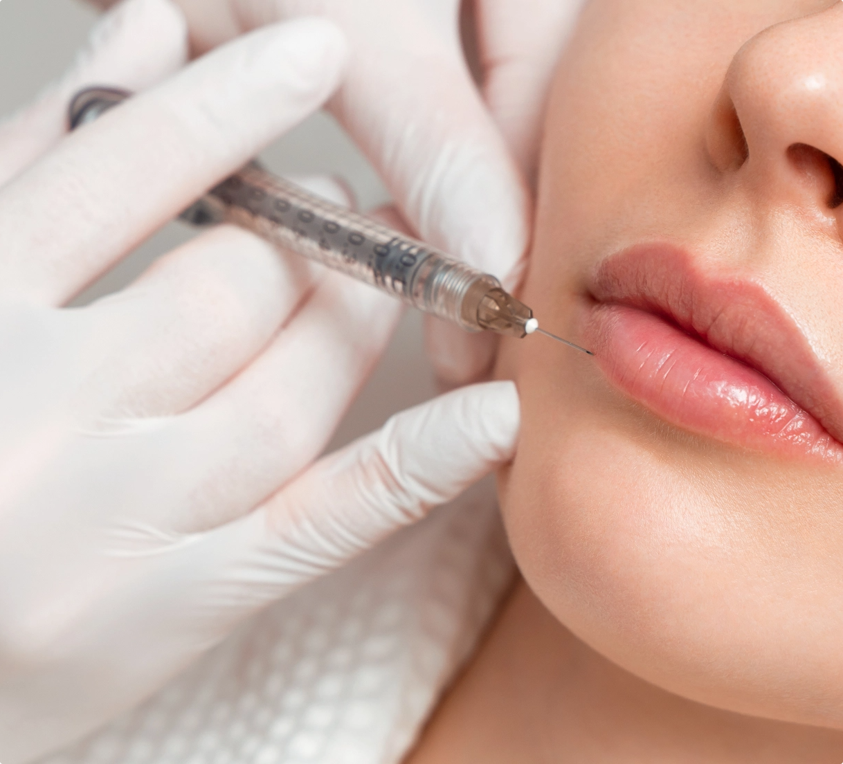 dermal filler injectable treatment