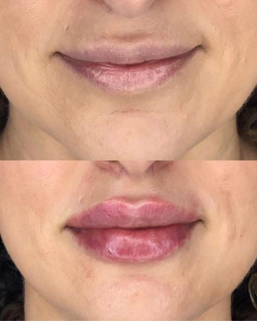 before and after dermal filler injectables