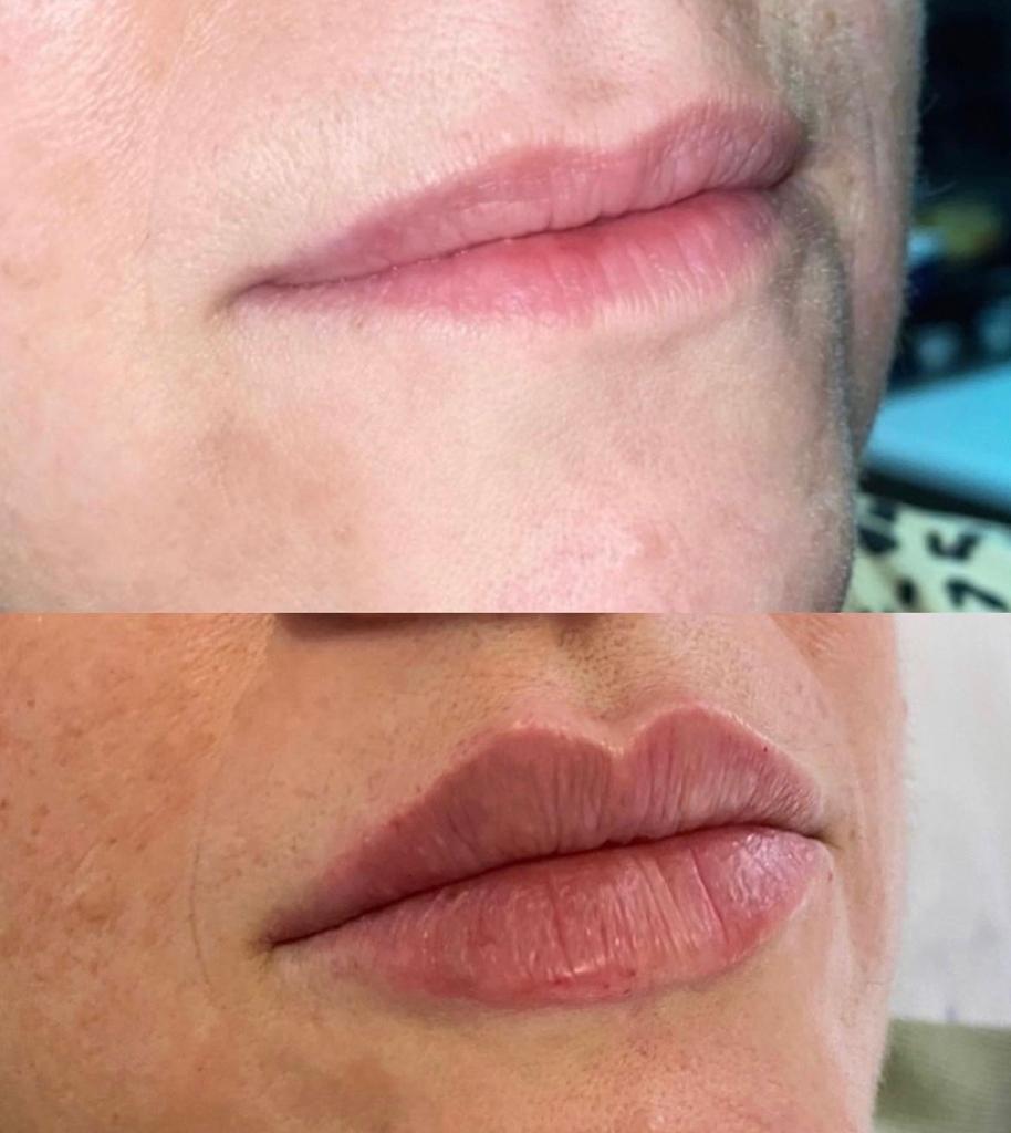 before and after dermal filler injectables