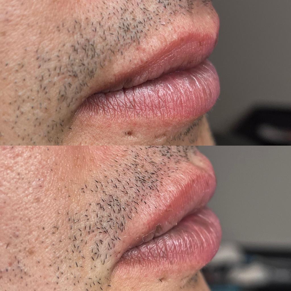 before and after dermal filler injectables