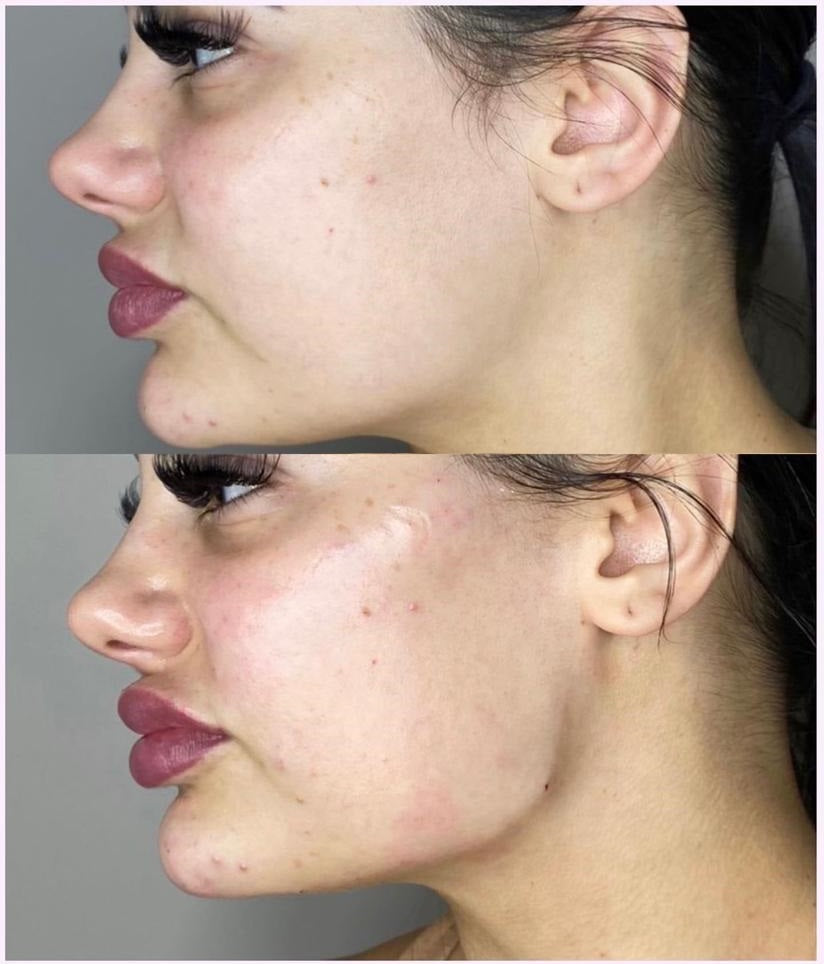 before and after dermal filler injectables
