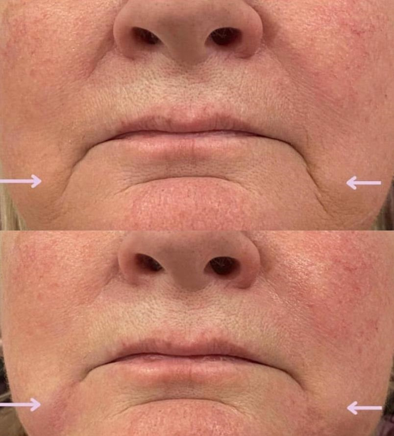 before and after dermal filler injectables