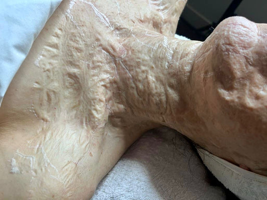 enzyme therapy mask