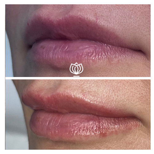 before and after lip filler