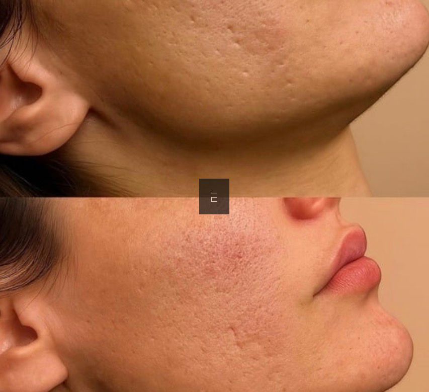 Secret RF Skin Needling