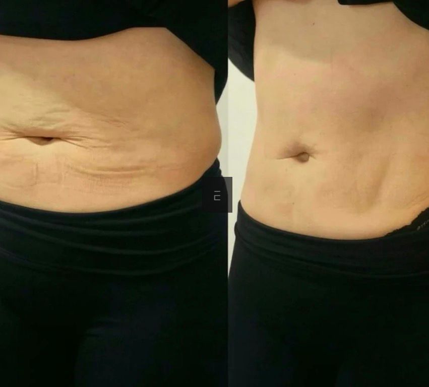 Secret RF Skin Needling