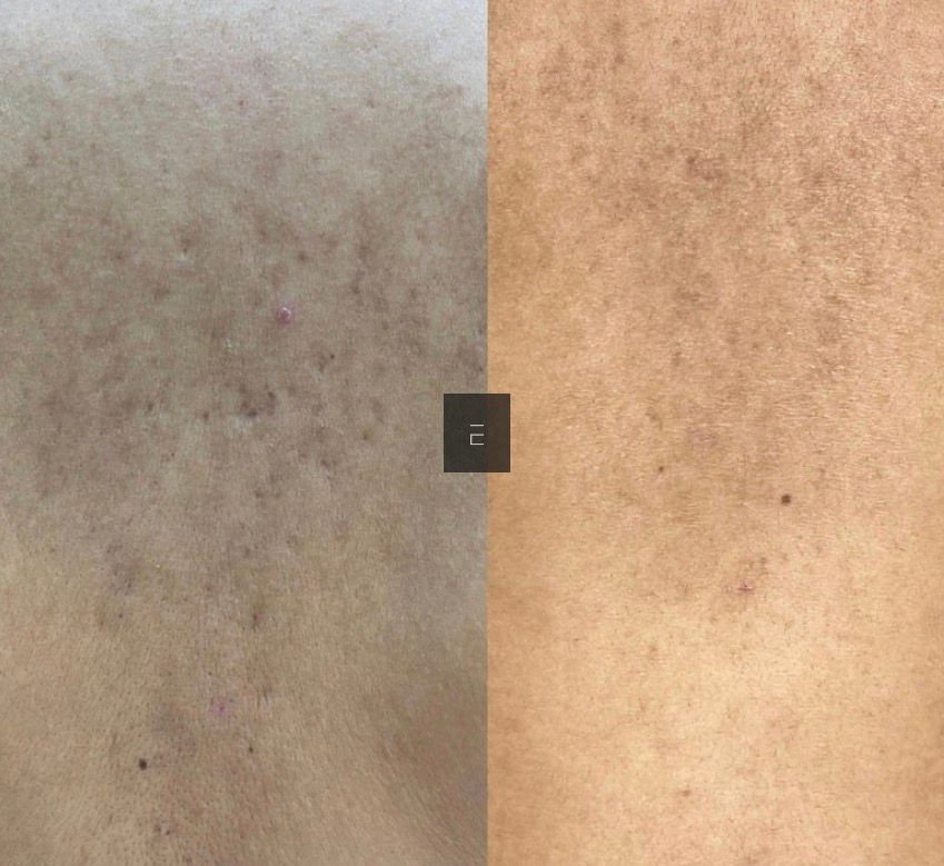 Secret RF Skin Needling