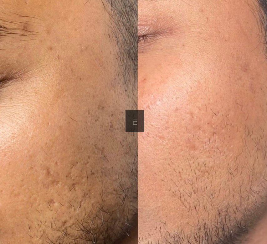 Secret RF Skin Needling